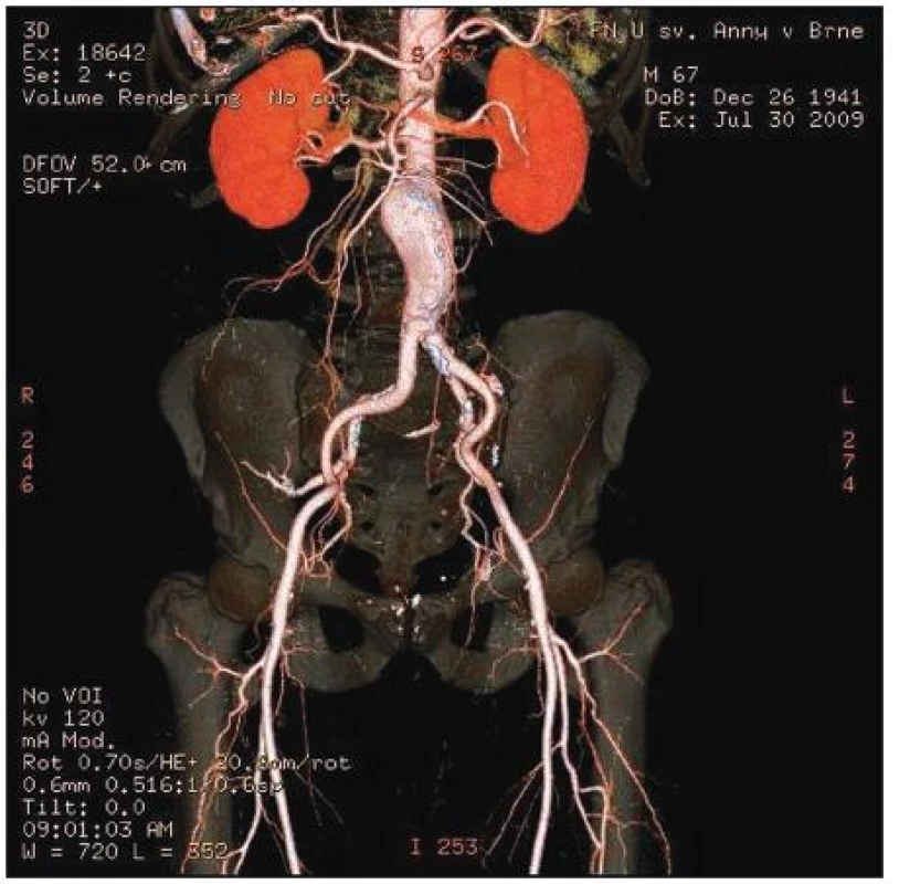 Předoperační CTAG abdominální aorty a pánevních cév
Fig. 2. Preoperative CTAG of abdominal aorta and iliac arteries