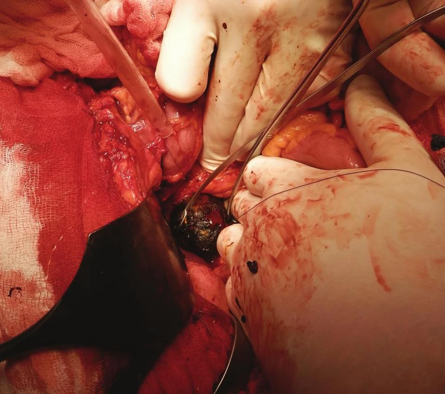 Odstranění žlučového kamene z podélné duodenotomie
Fig. 6: Extraction of the gallstone through a longitudinal duodenotomy