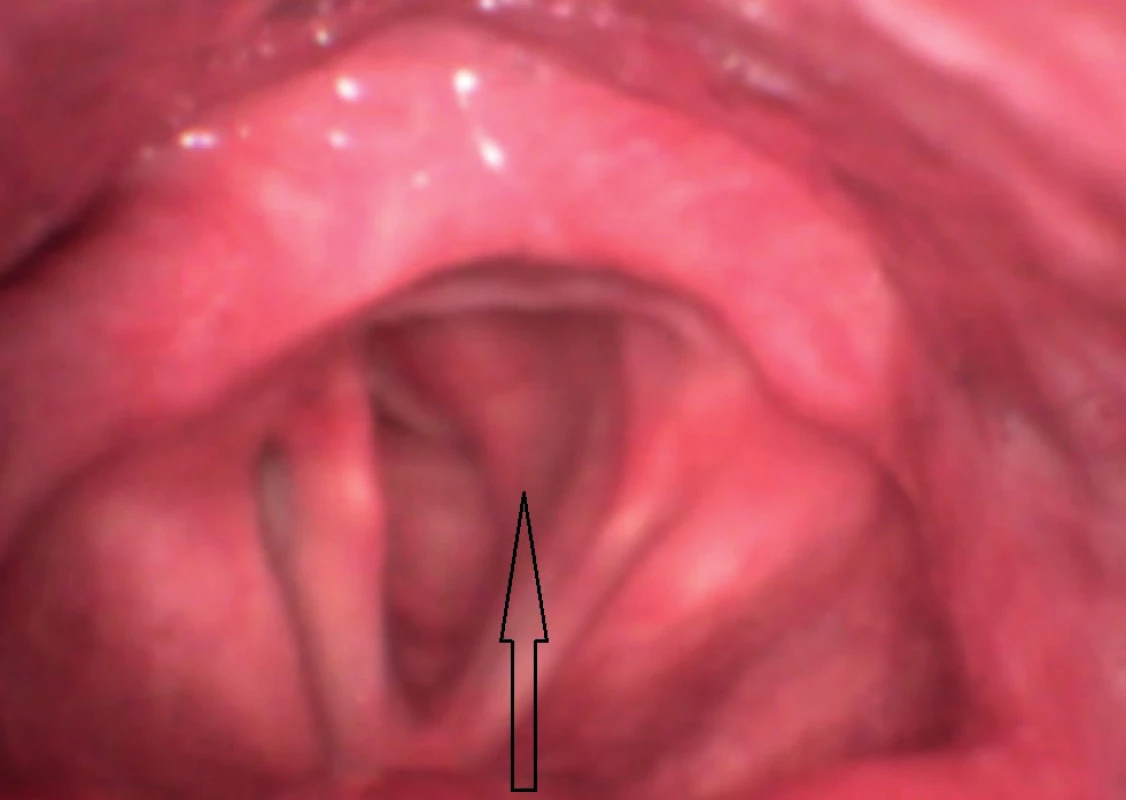 Předoperační flexibilní endoskopie – hladké růžové vyklenutí pod levou hlasivkou zasahující nejméně do poloviny lumina hrtanu.