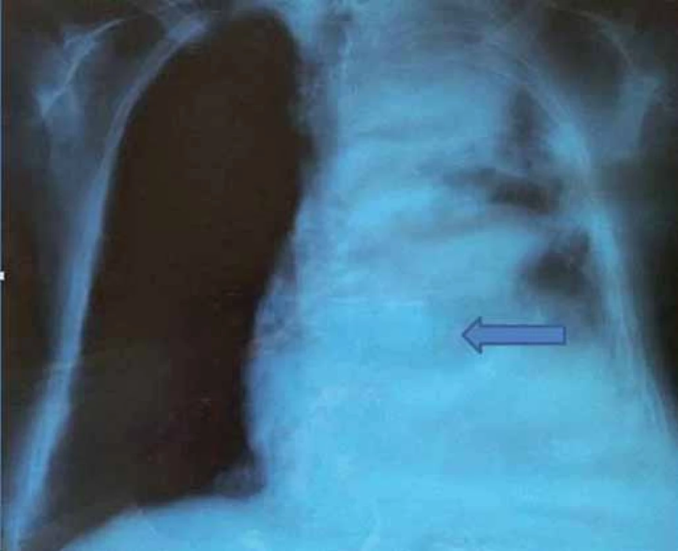 RTG snímka hrudníka – nehomogénne zatienenie celého ľavého krídla pľúc.