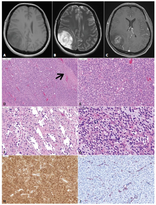 Glióm parietálneho laloka vpravo u 36 ročnej ženy s anamnézou niekoľo dní trvajúcich bolestí hlavy. MRI vyšetrenie ukázalo nepravidelné izo- až hypodenzné nádorové ložisko s rozsiahlym perifokálnym edémom, cystickou zložkou a prstencovitým vychytávaním kontrastnej látky (A, T1; B, T2; C, T1 s gadolíniom). Mikroskopicky sa jednalo o difúzne infiltrujúci gliový nádor s relatívne pravidelnou monotónnou hypercelularitou, ložiskami nekróz (šípka) a delikátnymi kapilárami (D). Nádorové bunky mali okrúhle jadrá a perinukleárne haló, obraz bol sugestívny pre diagnózu oligodendrogliómu (E). Ložiskovo boli zachytené mikrocysty, nádorové bunky v týchto častiach však mali skôr morfológiu astrocytómu (F,G). Imunohistochemicky bola dokázaná expresia IDH1 (H) a strata jadrovej expresie ATRX (J). Overexpreia p53 nebola prítomná. Nádor bol klasifikovaný ako glioblastóm, IDH-mutovaný, WHO grade IV. Klinicky sa jednalo o tzv. primárny glioblastóm (bez anamnézy resp. progresie z low-grade gliómu). Keďže väčšina IDH-mutovaných glioblastómov vzniká progresiou z low-grade IDH-mutovaných gliómov (tzv. sekundárny glioblastóm), je možné, IDH-mutované primárne glioblastómy vznikajú rýchlou progresiou klinicky nemého low-grade gliómu.