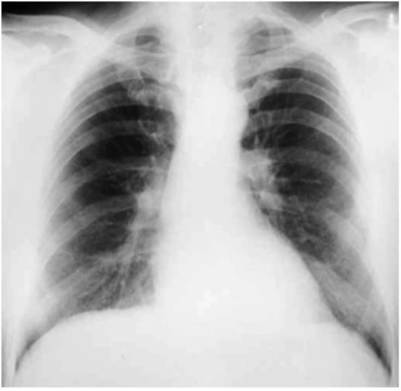 Předozadní snímek pacienta s azbestózou
Patrná jsou mnohočetná malá jemná ložiska fibrózy v charakteristických oblastech dolních plicních segmentů způsobující „rozmazání“ srdečního stínu a okraje bránice.