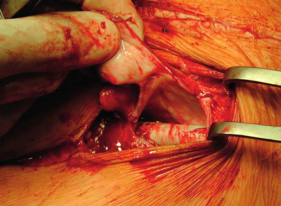 Distal anastomosis of the axillofemoral bypass before its explantation with visible pseudocapsule