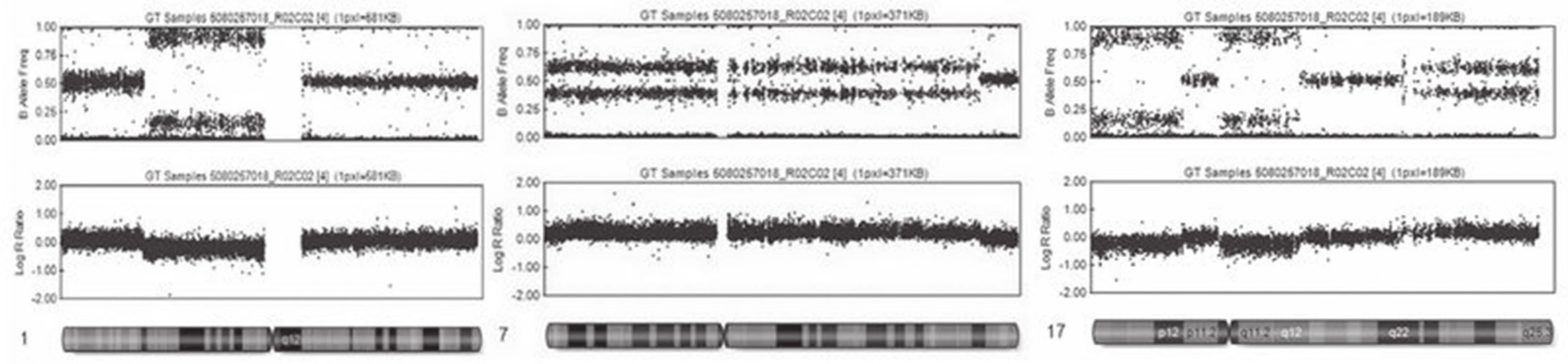 Výsledky vyšetření SNP array. Horní řádek udává B alelické rozložení, dolní řádek pak intenzitu fluorescence. V levé části je patrná delece části krátkých ramének prvního chromozómu. Uprostřed je ukázka zmnožení velké části 7. chromozómu a napravo komplexní změna 17. chromozómu, kde na krátkých raméncích 17. chromozómu nalézáme dva úseky s delecí, a naopak část dlouhých ramének 17. chromozómu, má zmnožení genetického materiálu.