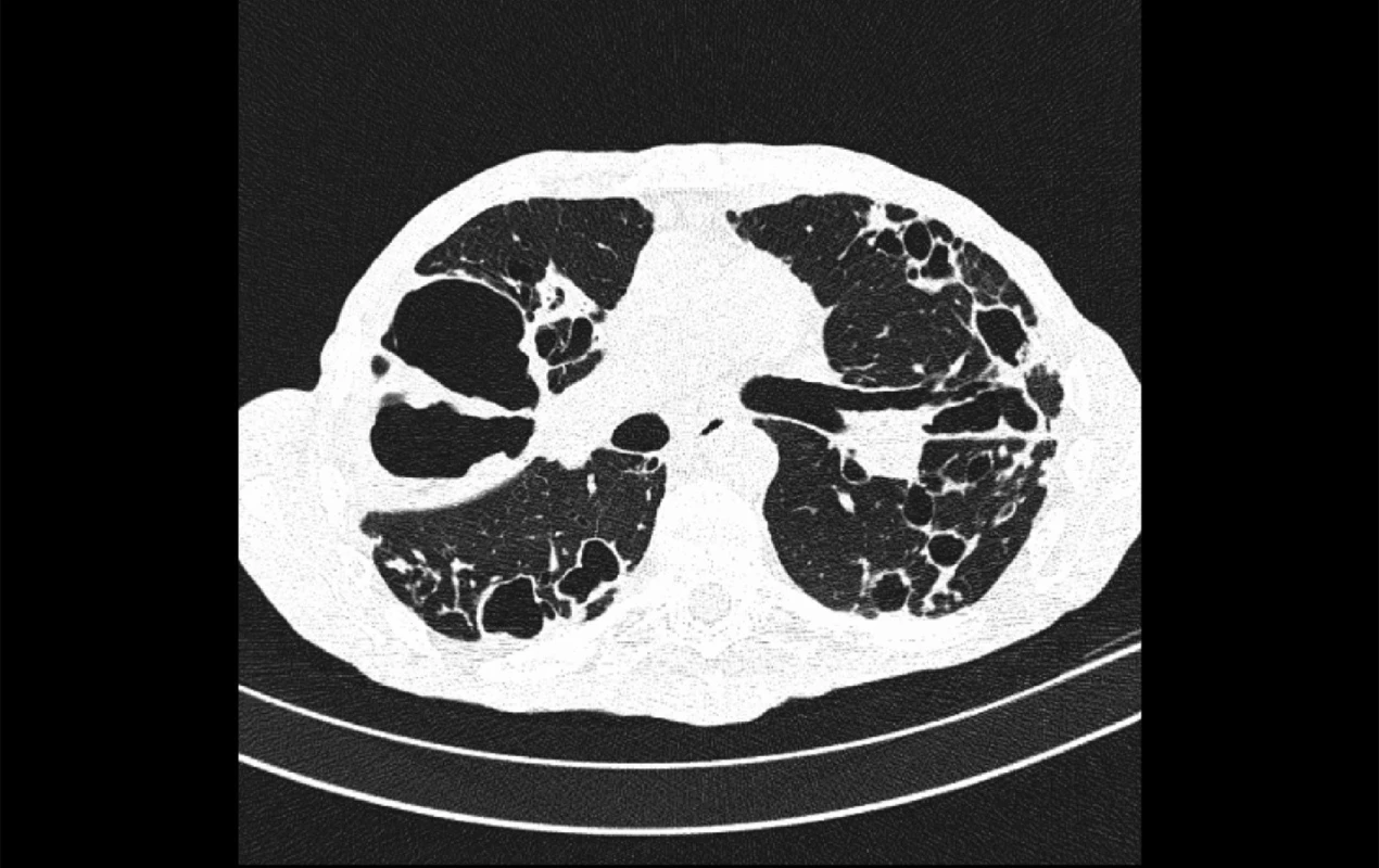 CT hrudníku. Bronchiektázie a kaverna u pacienta s plicní mykobakteriózou – M. avium
