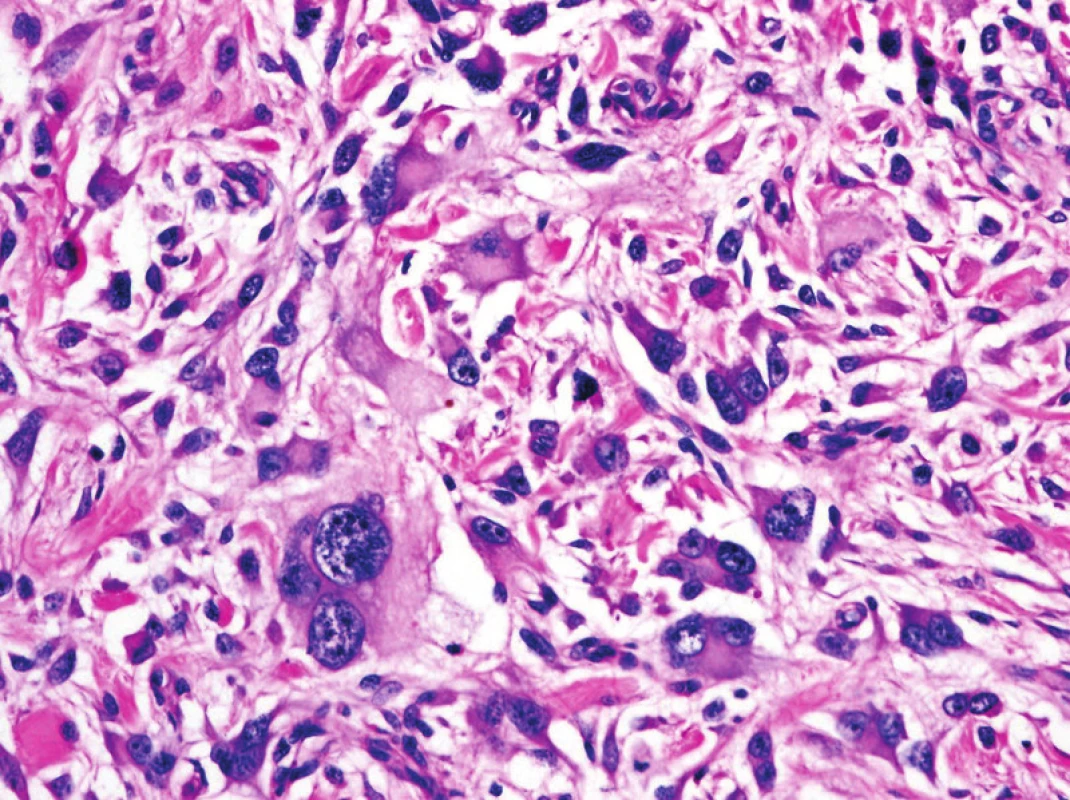 Nediferencovaný pleomorfní sarkom, dříve označovaný jako tzv. pleomorfní maligní fibrózní histiocytom (MFH), byl řazený mezi tzv. “fibrohistiocytární” tumory. Nyní patří do samostatné kategorie nediferencovaných / neklasifikovaných sarkomů, tedy maligních mezenchymálních tumorů, u kterých nelze prokázat žádnou linii diferenciace. Termín MFH je již obsolentní (původní zvětšení 200x).