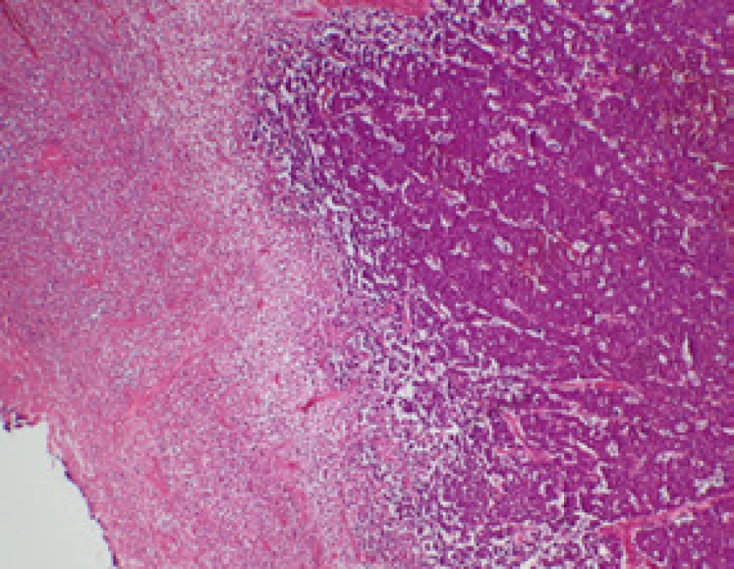 Histologický preparát – plazmablastický lymfom (vpravo), nekrotická povrchová zóna (vlevo), (Hematoxylin – eosin, zvětšení 40x, foto Radim Žalud)
Fig. 2. Plasmablastic lymphoma – necrotic surface zone (Photo R. Žalud)