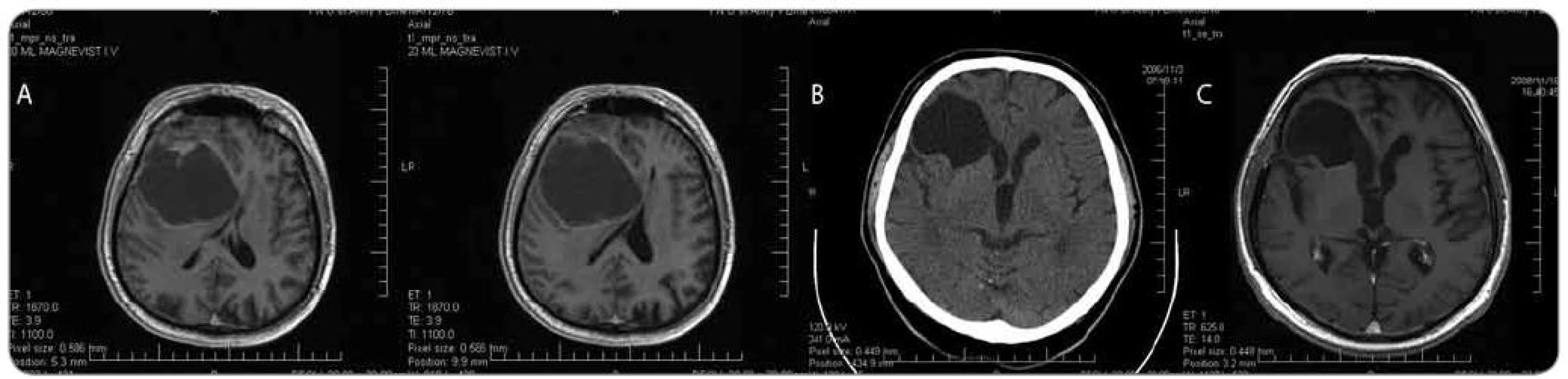 Muž, 64 let, klinicky nitrolební hypertenze, levostranná hemiparéza, pro meningizmus hospitalizace KICH. a) MRI mozku s nálezem cystické expanze frontálně vpravo s přetlakem středočárových struktur, b) endoskopická revize s odběrem biopsie ze stěny cysty, fenestrace cysty do komory, histologicky anaplastický astrocytom; CT s odstupem 3 týdnů po výkonu, c) MRI kontrola s odstupem přibližně 2 let po výkonu. Po komplexní onkologické léčbě přežití 3 roky, stav po plicní embolii v pooperačním období.