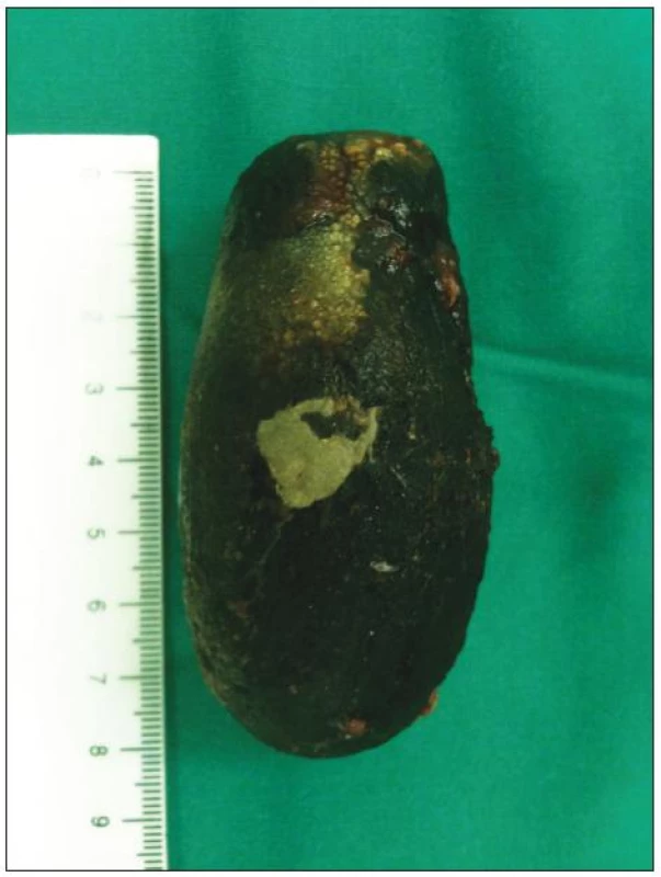 Extrahovaný cholelit z duodéna
Fig 4. The extracted gallstone