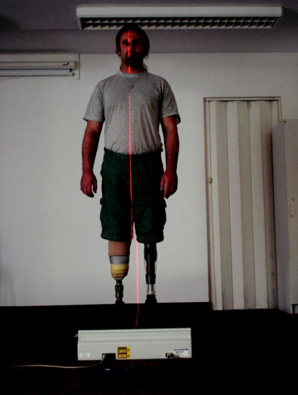 Pacient po amputaci PDK ve stehně a LDK v bérci – vyšetření pomocí L.A.S.A.R. Posture.
