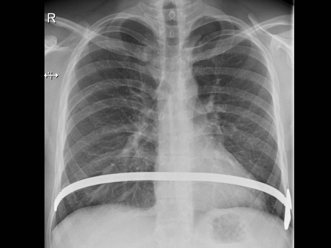 Korekční dlaha – RTG snímek po operaci.
Fig. 4. Correction bar – X-ray picture after the surgery.