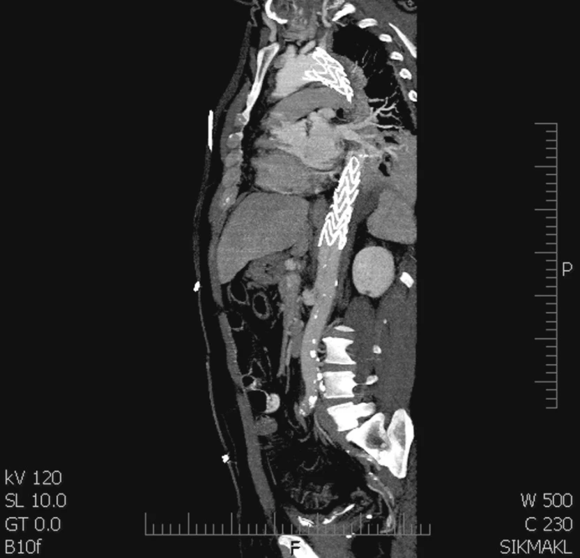 Stentgraft hrdlem překrývá levou a. subclavii a končí nad viscerálním segmentem
Fig. 3. A stentgraft covering the left subclavian artery and ending cranial to  the visceral segment