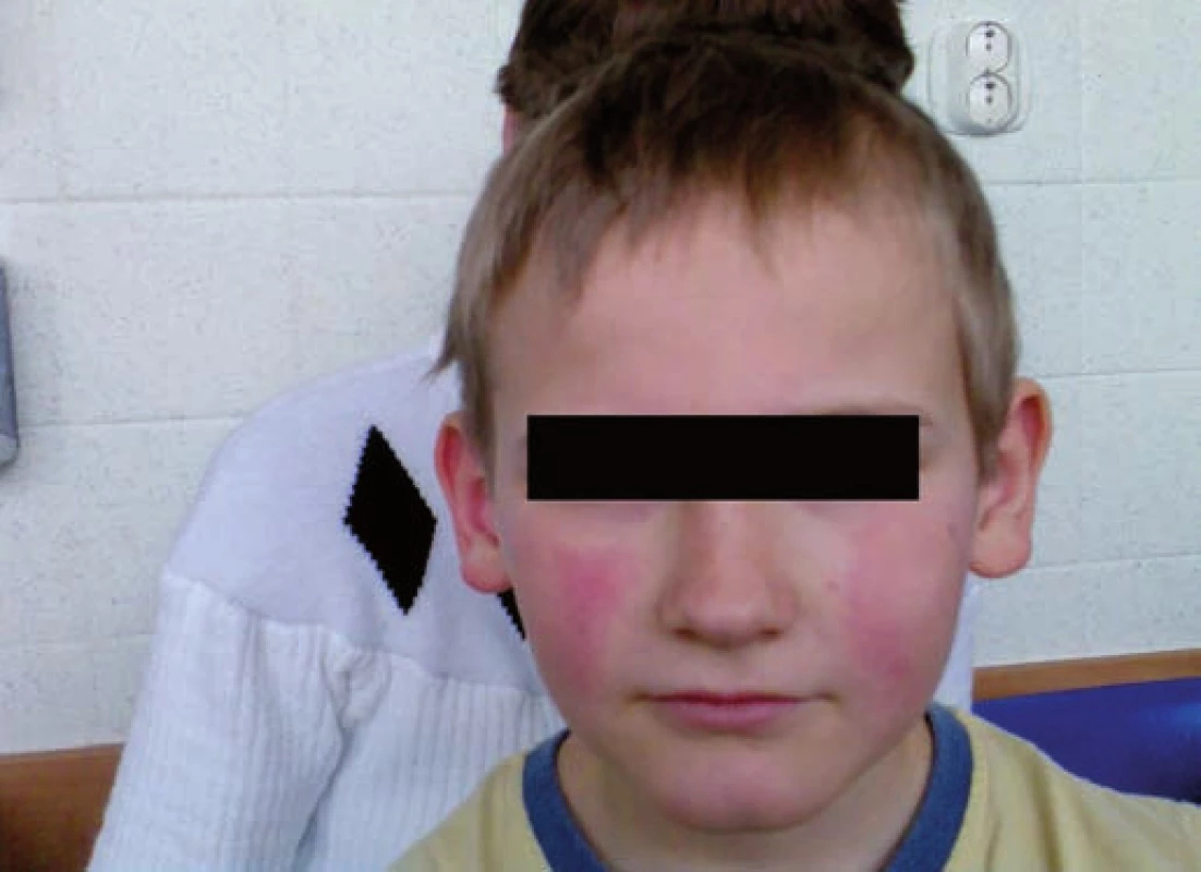 Erythema infectiosum: obraz „zpolíčkované tváře“ u pacienta č. 2.
Fig. 1. Erythema infectiosum: image of „slapped cheek” in patient No. 2.