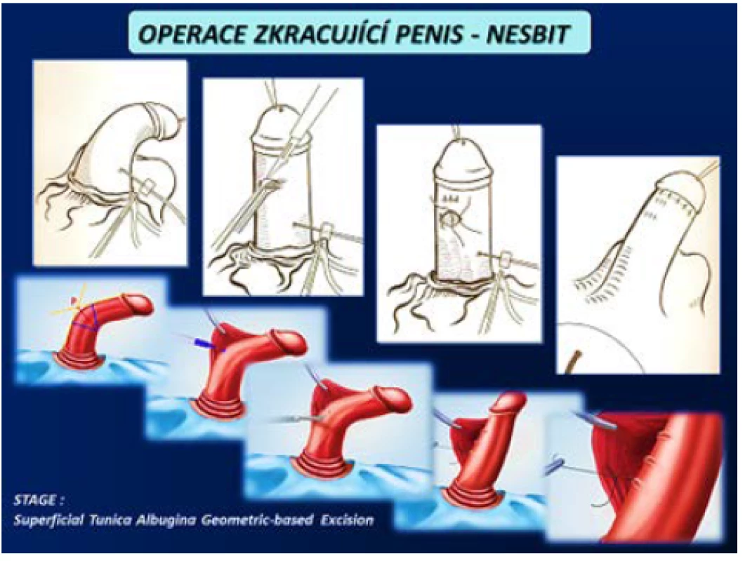 Operace zkracující penis – Nesbit (4)
Fig. 13 Shortening procedures of penis – Nesbit (4)