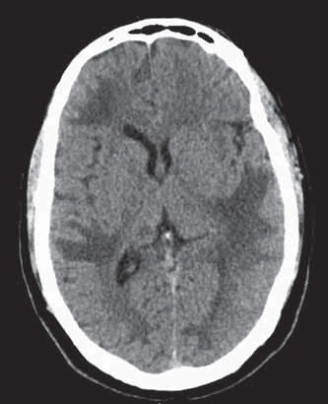 CT mozku u pacienta s TB abscesem mozku.