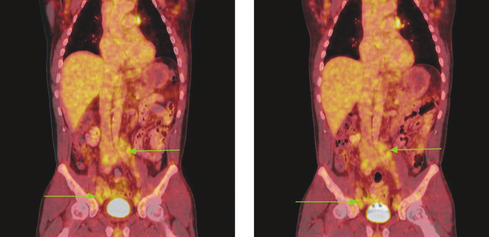 Série PET/CT snímků u nemocného s lymfomem z plášťových buněk před léčbou a po 2 cyklech léčby. Na prvním snímku jsou patrné zvětšené lymfatické uzliny vykazující hypermetabolismus glukózy v retroperitoneu a podél ilických tepen, nad tříselnými vazy a v tříslech. V některých lokalizacích lymfatické uzliny splývají až v pakety. Na druhém snímku přetrvávají zvětšené lymfatické uzliny a jejich pakety s hypermetabolismem glukózy v identických lokalizacích jako při předchozím vyšetření. Nedošlo rovněž ke zmenšení velikosti uzlin, resp. jejich paketů.