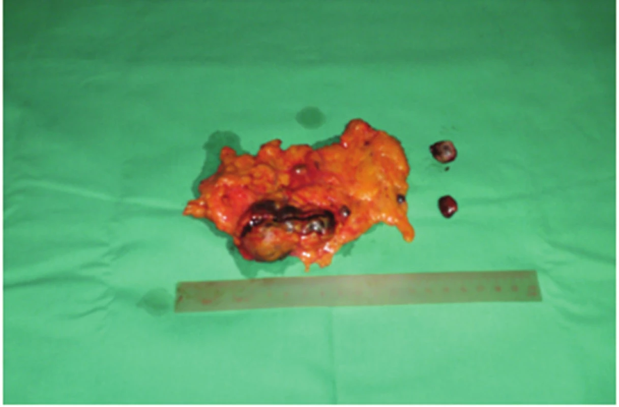 Odstránená časť omenta s implantovaným tkanivom sleziny a dve samostatné ložiská
Fig. 2: Removed part of the omentum with implanted splenic tissue and two separate deposits