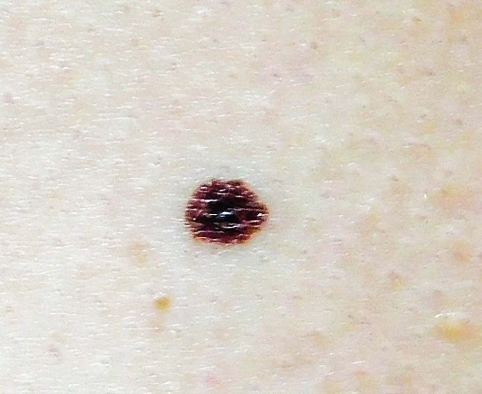 Povrchově se šířící melanom &lt;i&gt;in situ&lt;/i&gt; levé strany hrudníku