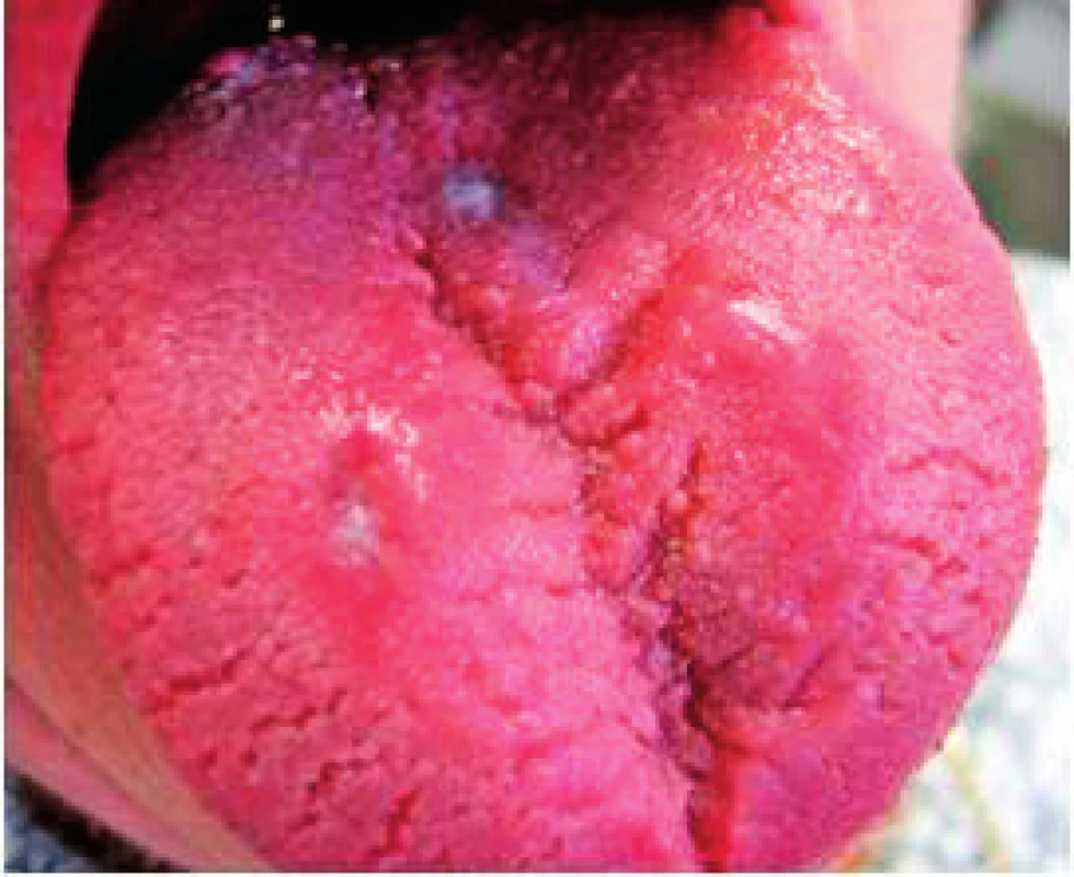 Linqua plicata. Rýhovanie je lokalizované do tela jazyka a jeho pravého okraja. Na pravej polovine začína atrofická lichenifikácia (Vodrážka)