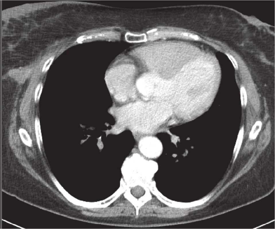 CT hrudníku v prosinci 2010
Fig. 3: Chest CT scan in December 2010