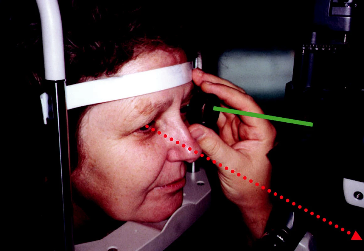 Fixace pravým okem při vyšetření VNV levého oka