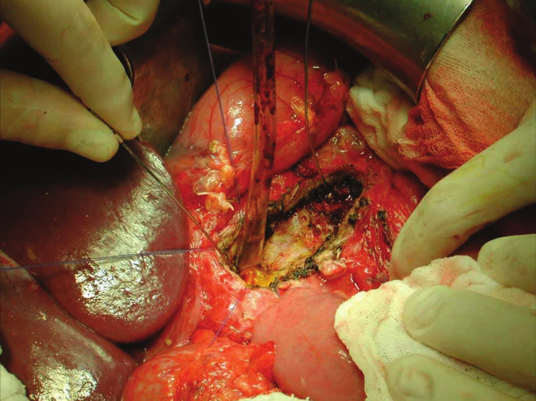Podélné protětí dilatovaného d. pancreaticus, tvrdá tkáň pankreatu při chronické pankreatitidě – operační foto