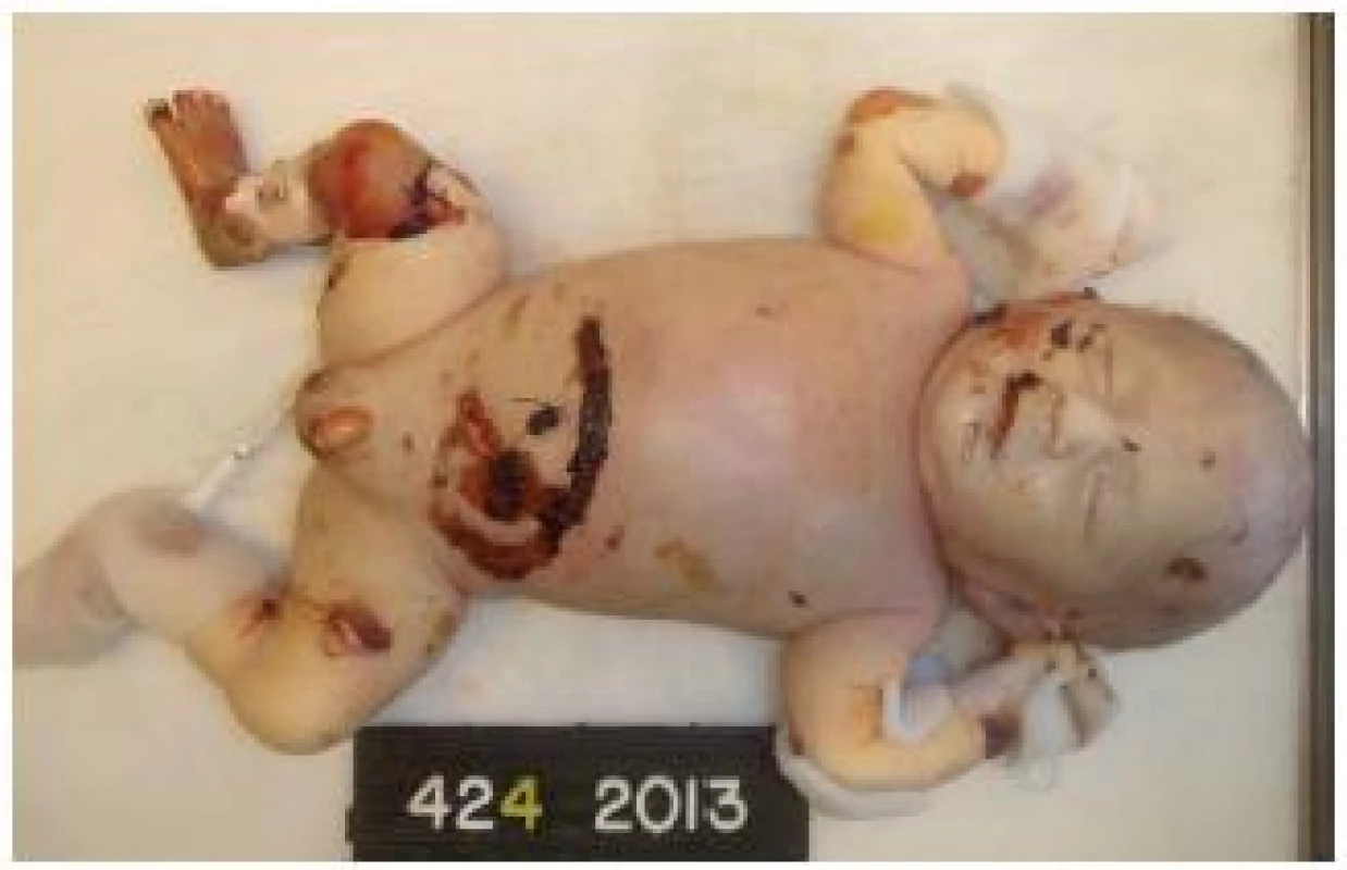 Celkový pohľad na telo mŕtveho novorodenca s absenciou kože na pravej dolnej končatine, s denudovanými pľuzgiermi a ranou po laparotómii pre atréziu pyloru.