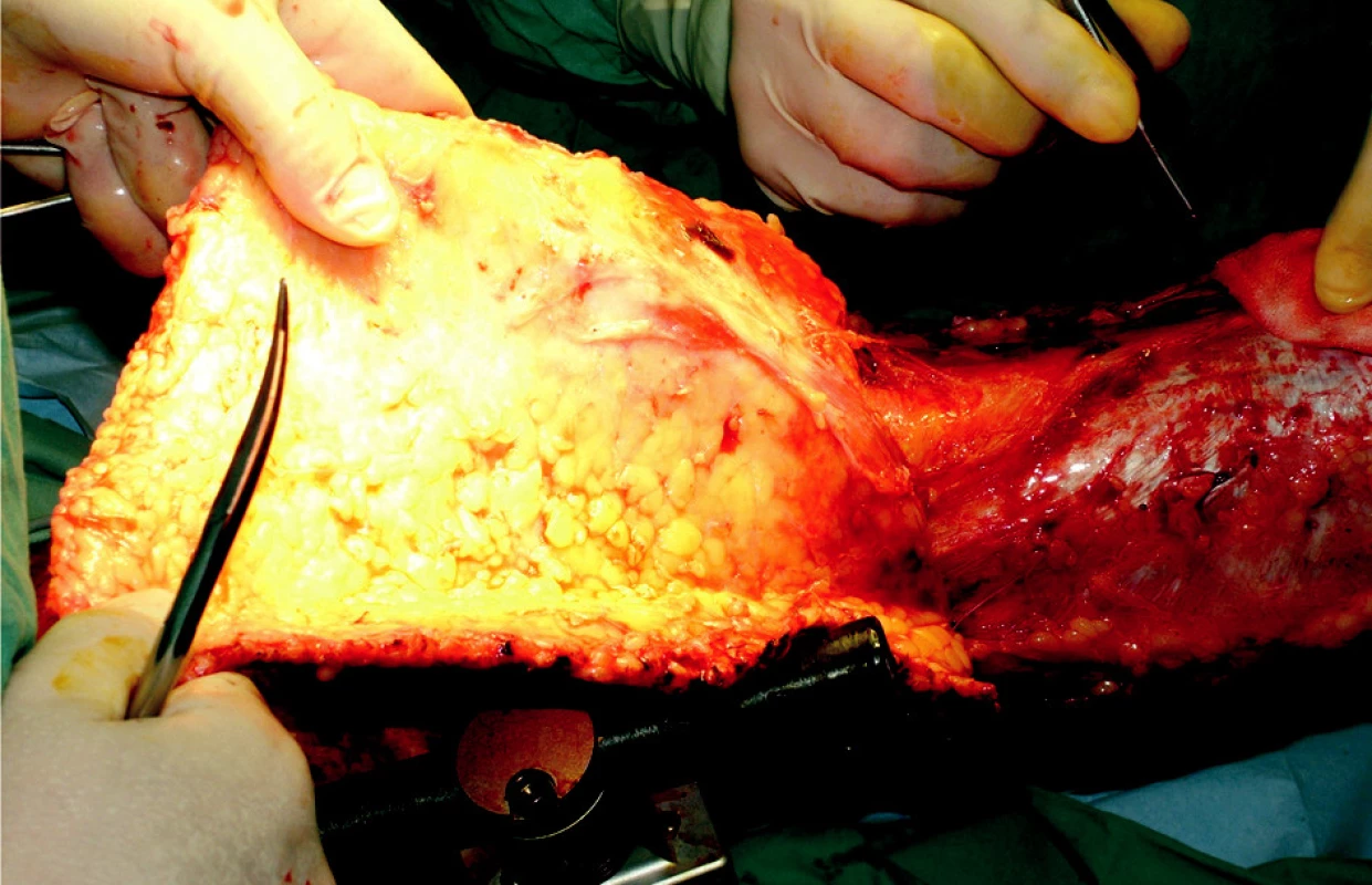 Epifascial necrectomy – avulsion on right lower extremity