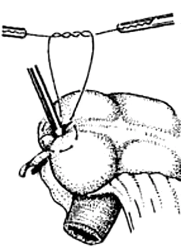 Laparoskopická apendektomie – laparoskopické zanoření pahýlu červu, peritonealizace
Fig. 7. Laparoscopic appendectomy – laparoscopic insertion of the appendix stump, peritonealization