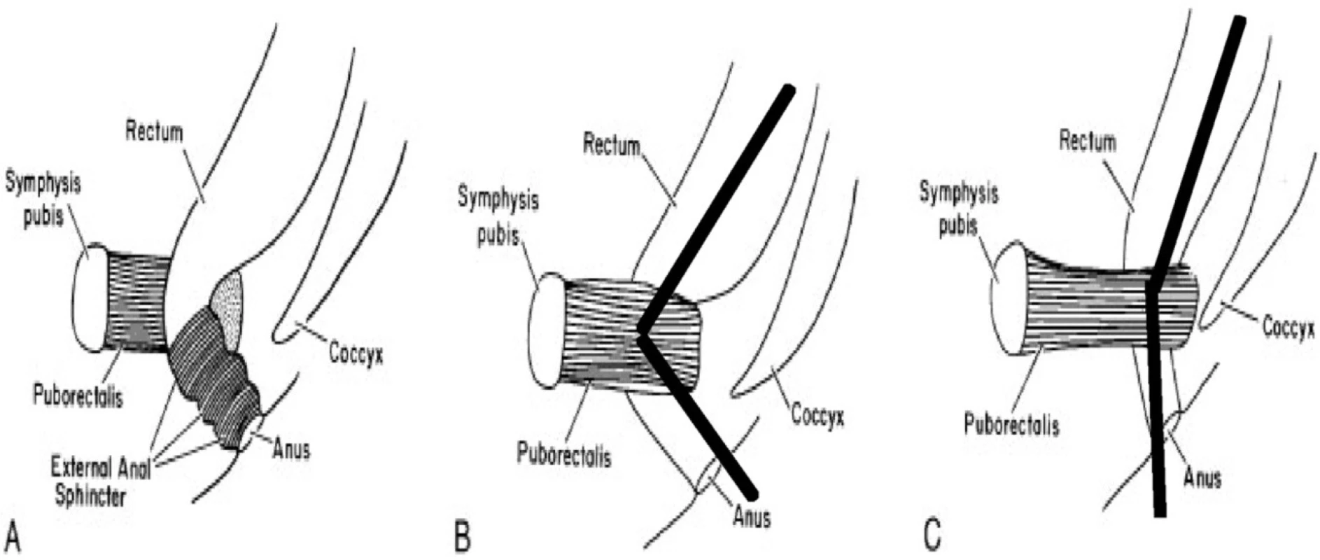 Mechanismus relaxace svalů pánevního dna při defekaci
A (vlevo): rektum a kontrahovaný m. puborectalis, ostrý anorektální úhel a zevní svěrač
B (uprostřed): klidový stav – kontrahovaný m. puborectalis a ostrý anorektální úhel
C (vpravo): defekace – relaxace m. puborectalis a napfiímení anorektálního úhlu