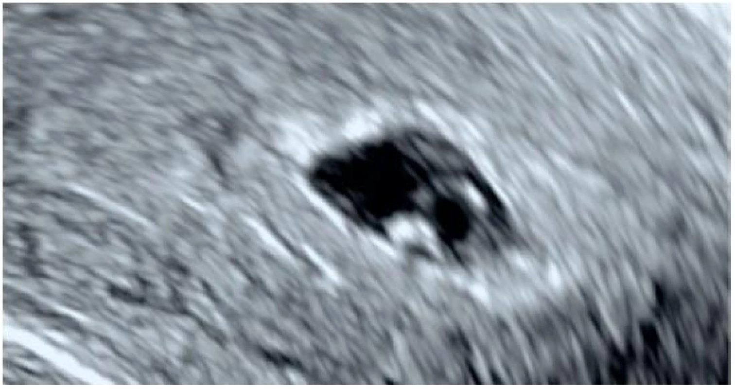 Intrauterinní těhotenství na konci 6. gestačního týdne
Ultrazvukové zobrazení gestačního váčku se sekundárním žloutkovým váčkem a embryem o maximální délce (CRL) 3,5 mm (odpovídá grav. hebd. 5+6), při vyšetření patrná pulzace (srdeční akce).