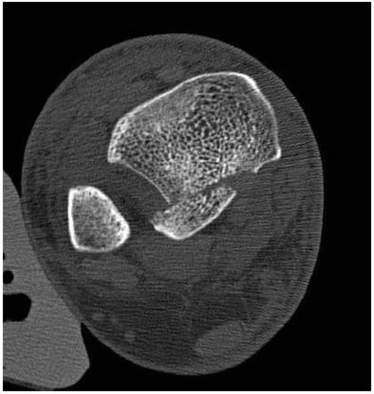 CT vyšetření ukazuje velikost odlomené zadní hrany méně než 25 %, dislokaci fragmentu fibulárně, rozšíření tibiofibulárního spojení 