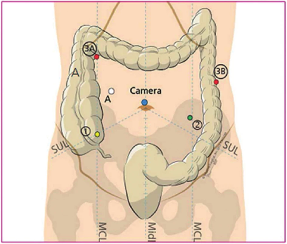 Rozmístění portů při da Vinci asistované resekci rekta (J. Lagares-Garcia)
Fig. 1. Port placement for da Vinci assisted low anterior resection of the rectum (J. Lagares-Garcia)
