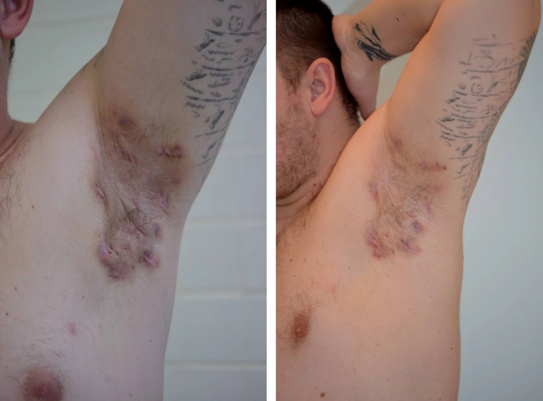 Axilární hidradenitis suppurativa – před a po 3 měsících terapie adalimumabem