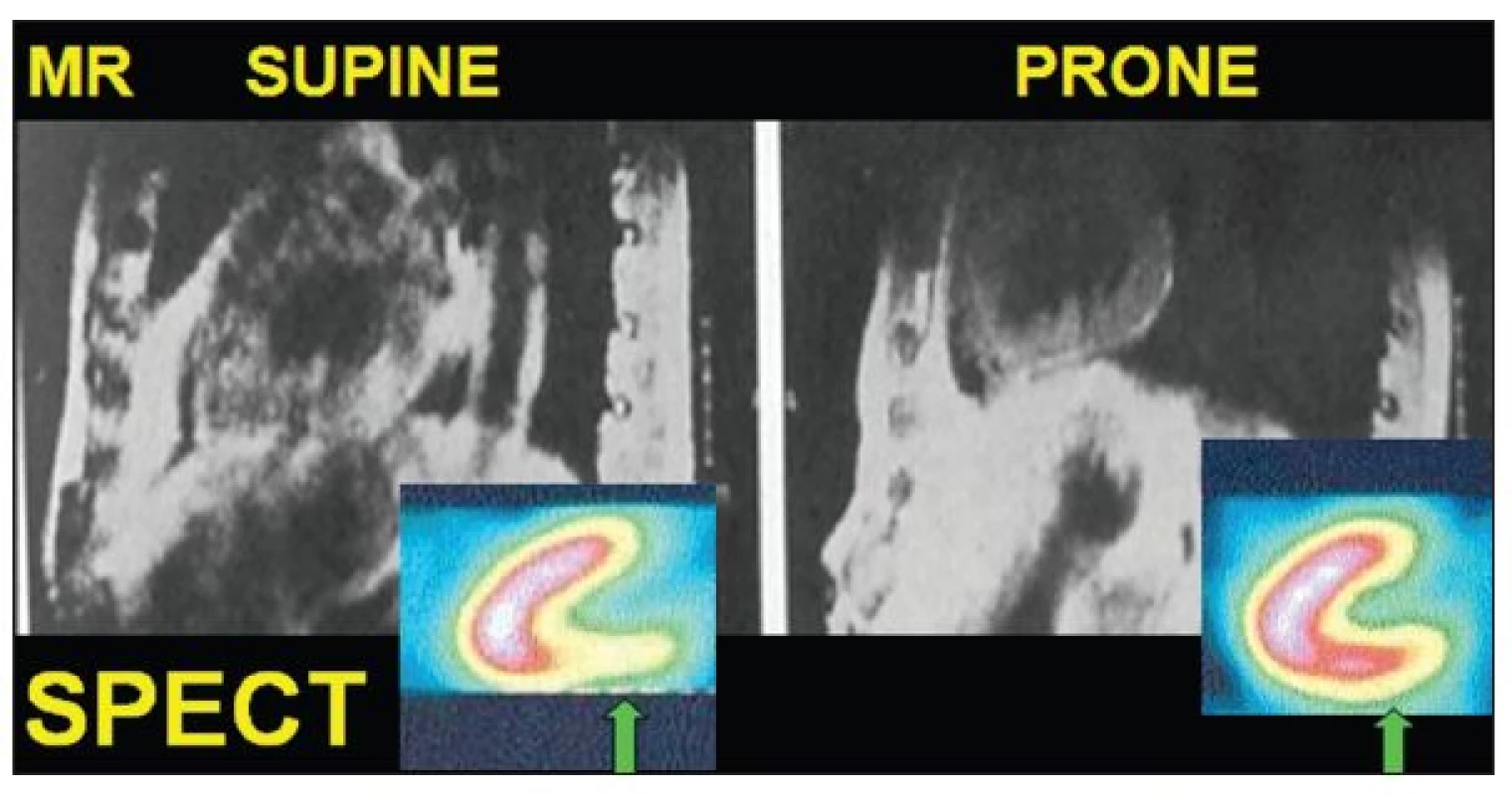 Změna polohy srdce patrná při zobrazení magnetickou rezonancí (MR) při porovnání supine 
a prone pozice. Arteficiálně snížené vychytávání impulsů v oblasti spodní stěny při SPECT zobrazení
 v supine pozici není patrné v prone pozici.