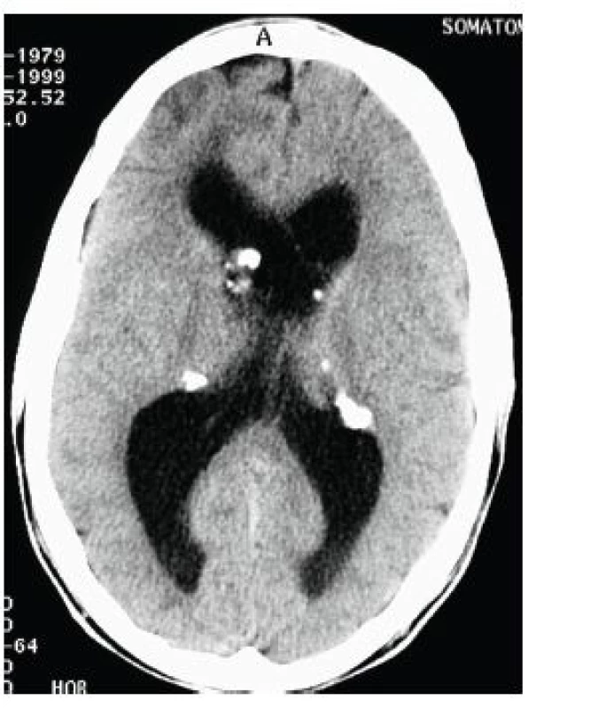 Vícečetné kalcifikované subependymální noduly (SEN) v oblasti postranních komor mozku oboustranně na CT vyšetření mozku u 20letého muže