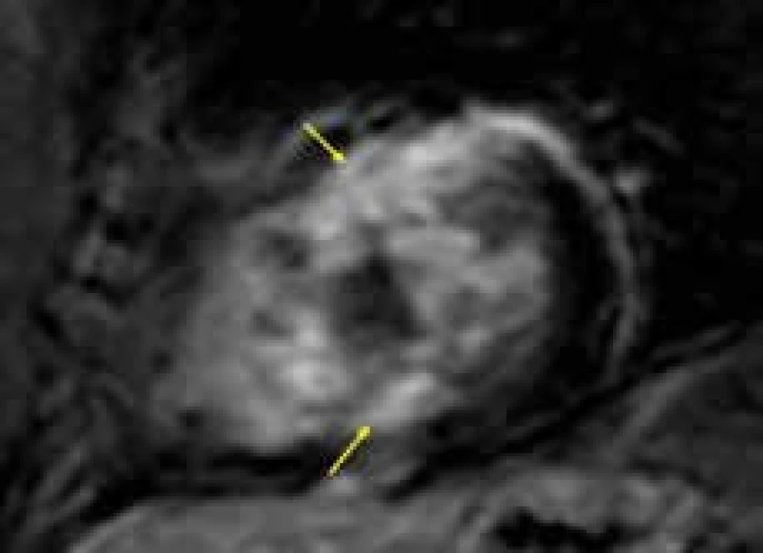 Řada splývajících ložisek pozdního sycení kontrastní látkou (LGE) (žluté šipky) v komorovém septu a přilehlé oblasti přední stěny u nemocného s hypertrofickou kardiomyopatií; projekce na krátkou osu levé komory