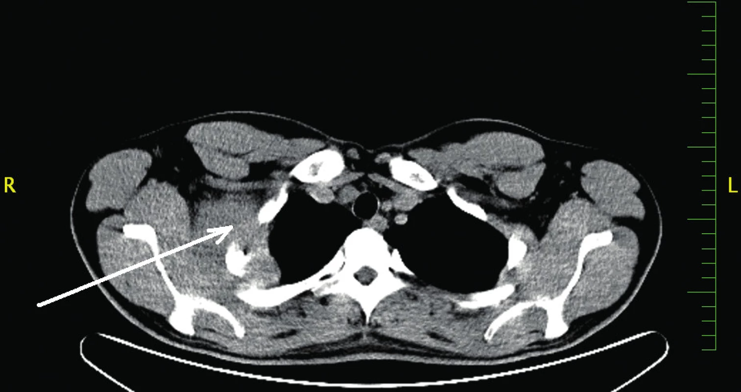 CT plic, kazuistika 2
Fig. 1: Thoracic CT scan, case report 2