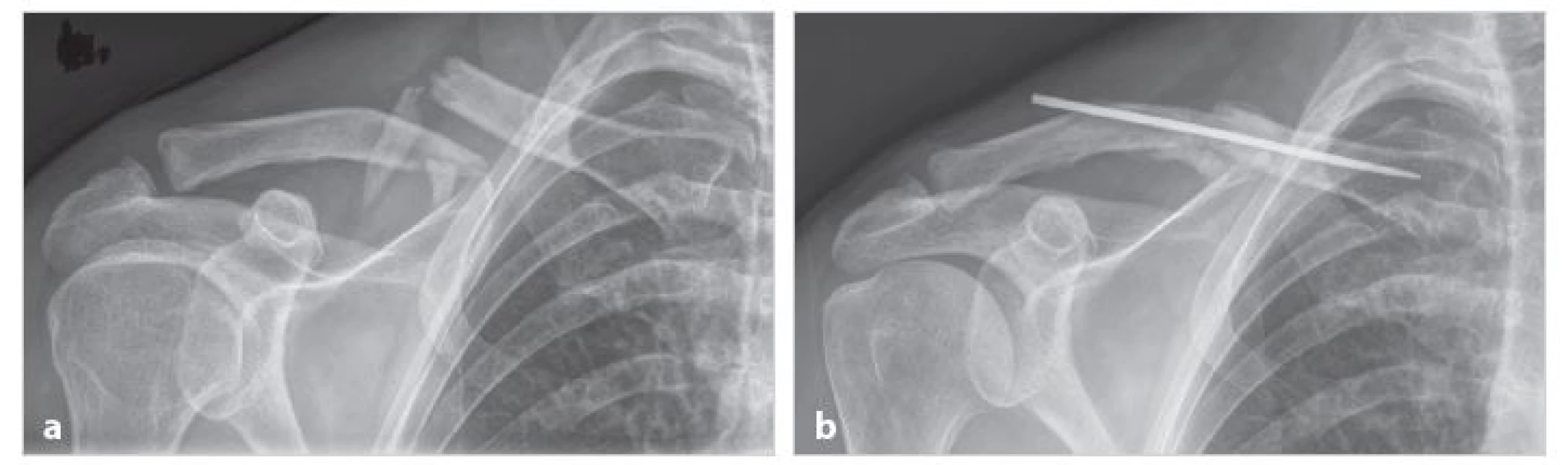 Nekomplikované hojení vícefragmentové zlomeniny střední části klíční kosti (muž V. H., 54 let)
a) úrazový snímek čtyřfragmentové zlomeniny; b) tři měsíce po operaci je zlomenina zhojena v dobrém postavení kostních fragmentů
Fig. 1: Uncomplicated healing of multifragment fracture of the clavice midshaft (male V.H., 54 years)
a) X-ray of a four-fragment fracture taken after the injury; b) three months after surgery with healed fracture and good position of bone fragments