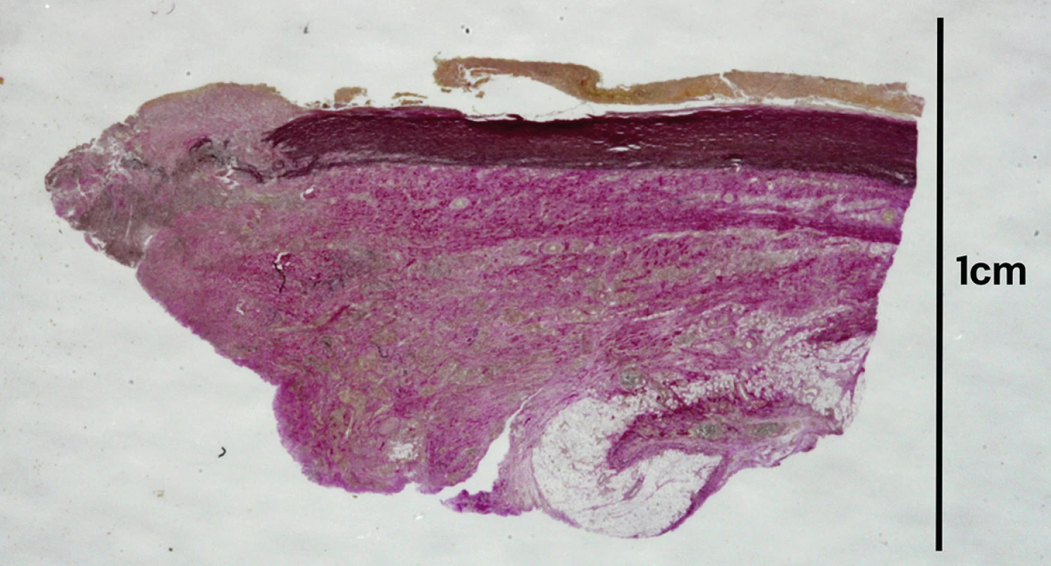 Histotopogram pseudoaneuryzmy aorty s fibroproduktívnymi zmenami (van Gieson 
+ elastika).