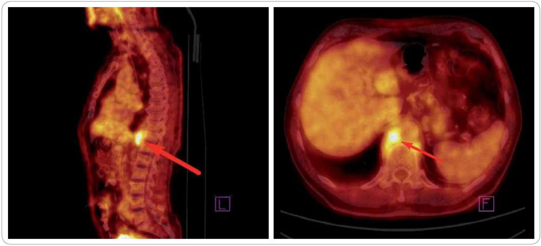 Obraz z celotělového PET/CT vyšetření před zahájením radioterapie (09/2010). Šipka ukazuje metabolicky aktivní infiltrát retrokrurálně.