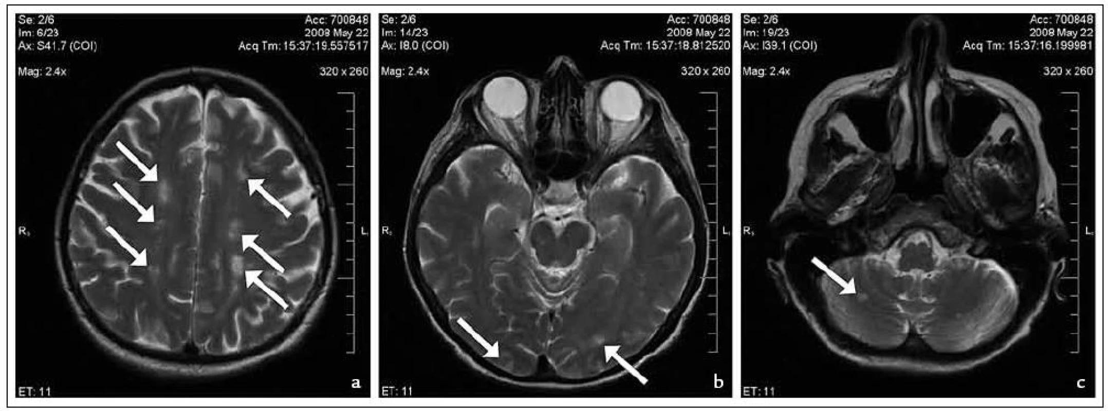 První MR mozku: vícečetná ložiska v centrum semiovale (a), v okcipitálním laloku a mezencefalu (b) a mozečkové hemisféře (c).