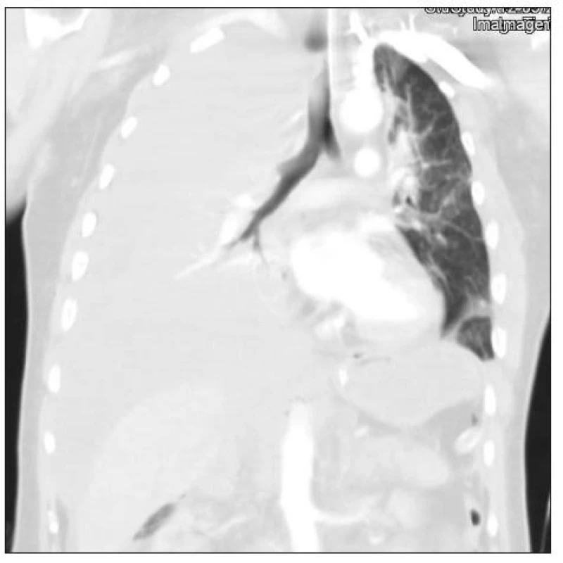 CT scan s nálezem hemotoraxu po ošetření břišního krvácení (270 minut od úrazu)
Fig. 2. CT scan detecting hemothorax after the management of abdominal bleeding (270 min after the injury)