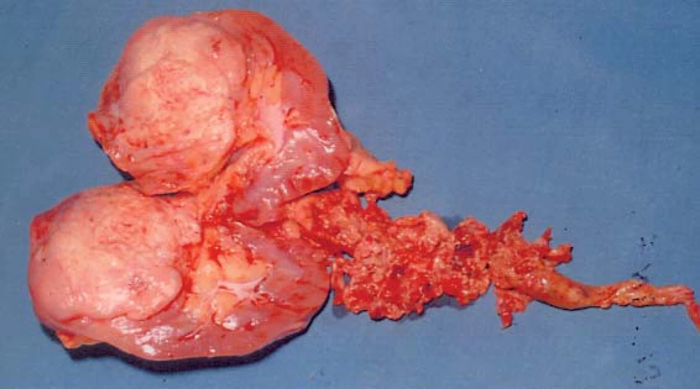 Odstraněná ledvina s nádorem a keříčkovitým trombem (hladina IV, operace v CPB).