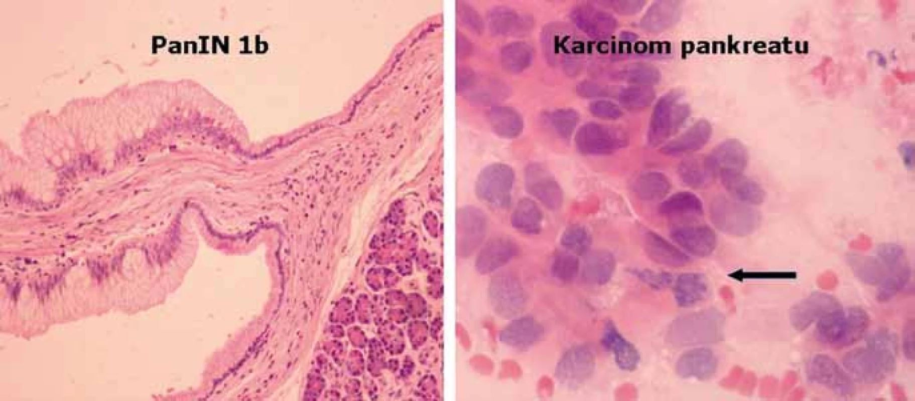 Histologický obraz léze PanIN1b a karcinomu pankreatu.