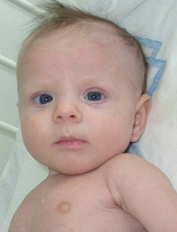 Pacient ve věku 2,5 měsíce.
Fig. 2. Patient at the age of 2.5 months.