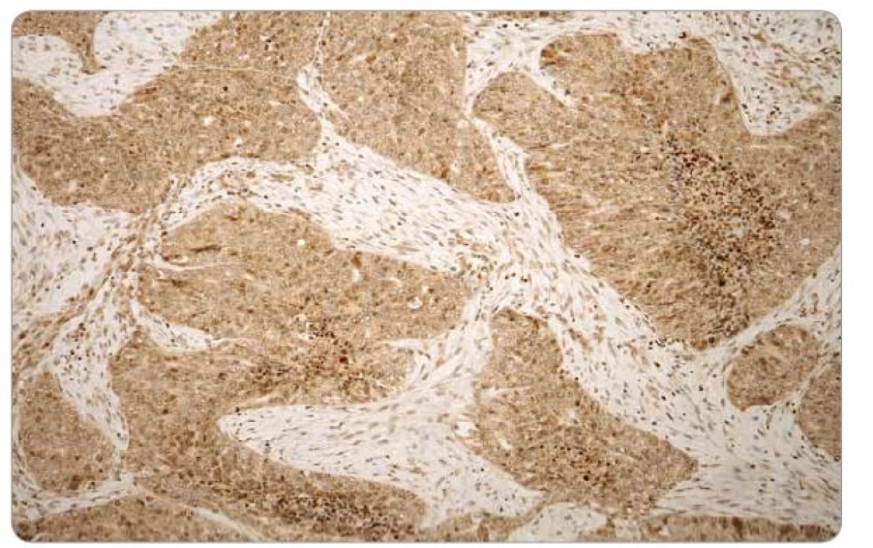 Difuzní exprese Pgp v nádorových buňkách high-grade serózního karcinomu ovaria (imunohistochemie, zvětšení 100x).