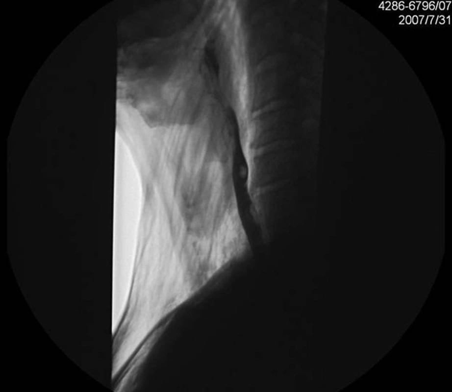 Pasáž GIT
Fig. 5. Swallowing act X-ray