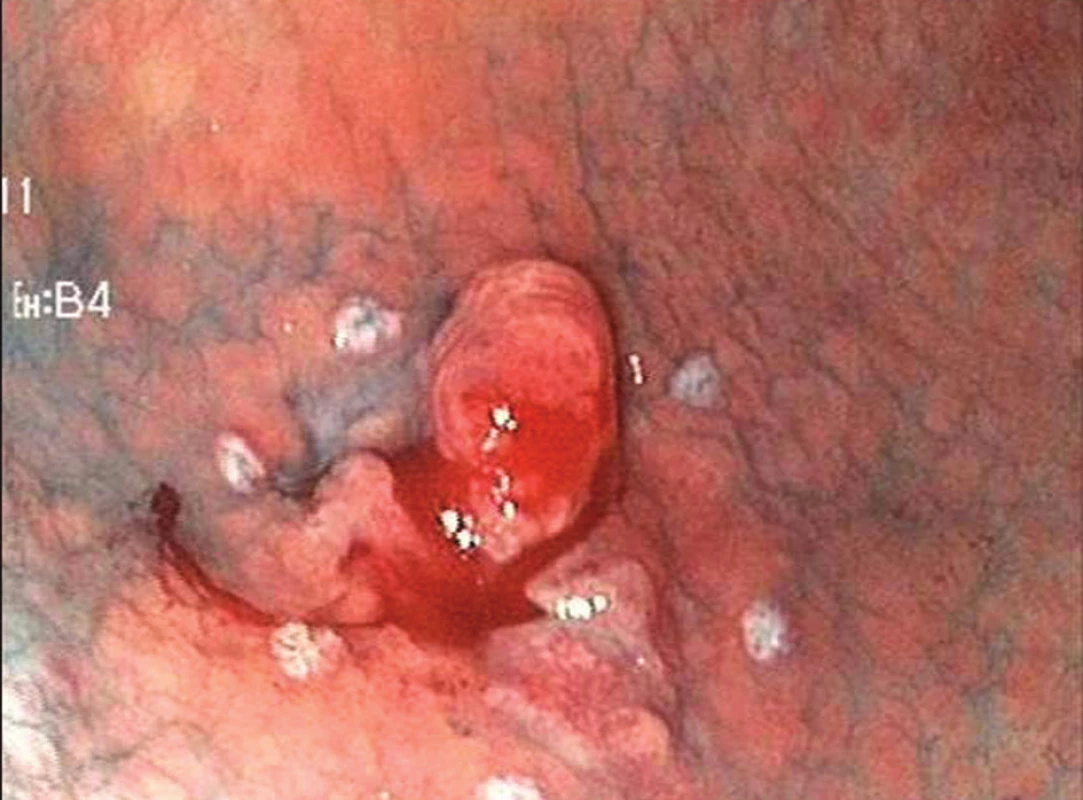 Časný karcinom žaludku typ 0IIc + Is o průměru 25 mm v antru žaludku (Chromodiagnostika indigokarmínem, okraj léze označen koagulačními body.)