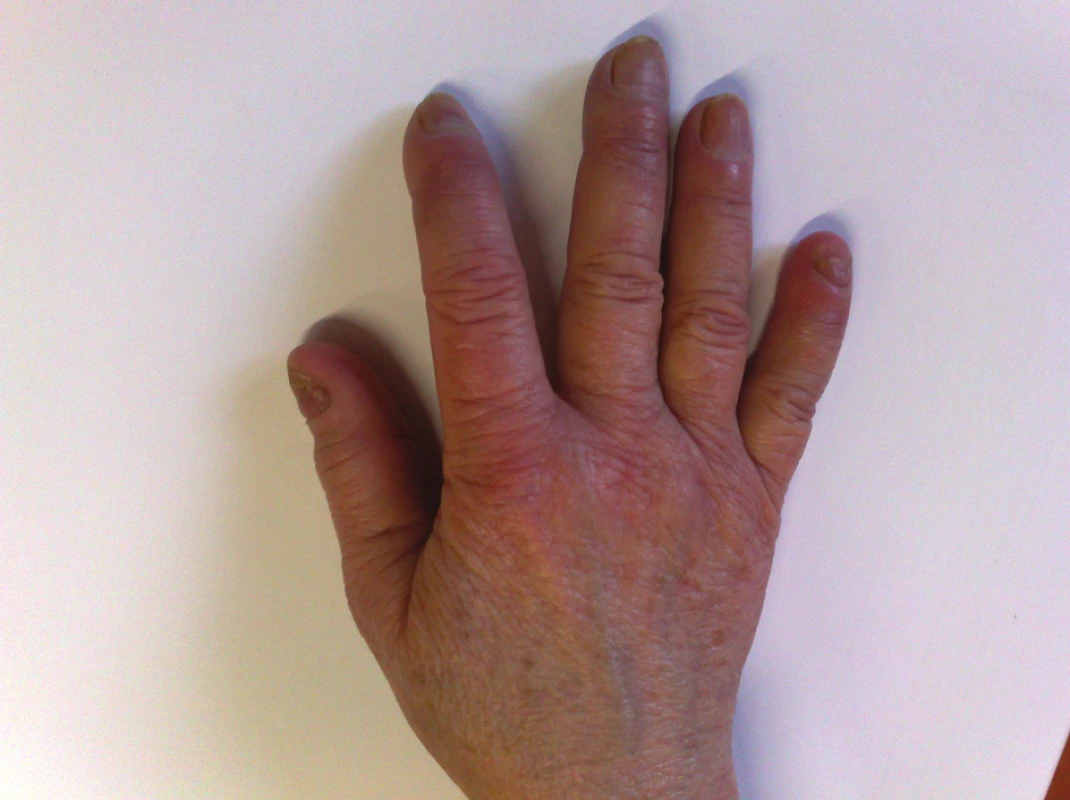 Ruka pacientky s kryoglobulinémií mimo ataku RF – trvající barevné změny a zhoršená kvalita nehtů.